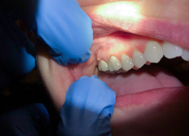 Best Emergency Dentist for Lost Fillings or Crowns in Wallace, NC