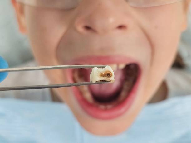 Best Emergency Dentist for Knocked-Out Tooth in Wallace, NC